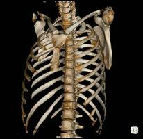 X-ray and CT Scan thoracic spine photo