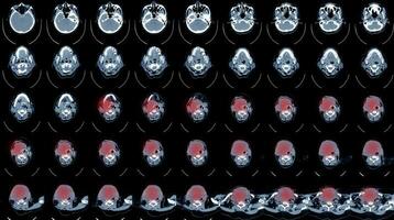 CT SCAN OF THE NECK HISTORY A69-year-old female presented with neck mass and right TVC paralysis. photo