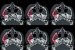 calculado tomografía de orbita desplazado fractura a lateral y medio pared de Derecha orbita. foto