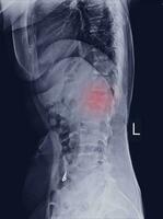 X-ray L-S Spine LATERAL Finding Moderate compression fracture of L1 vertebra. photo
