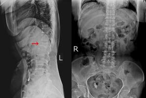 X-ray L-S Spine AP LATERAL Finding Moderate compression fracture of L1 vertebra. photo