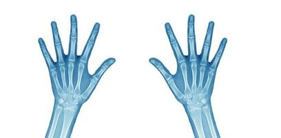 x-ray both hands on white background Medical image concept. photo