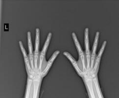 radiografía ambos manos en blanco antecedentes médico imagen concepto. foto