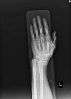 X-ray Left wrist joint Fracture with displacement distal end left radius. photo