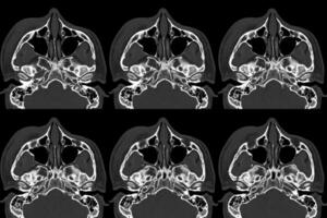 calculado tomografía de orbita desplazado fractura a lateral y medio pared de Derecha orbita. foto