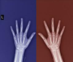 film x-ray both hand AP  show normal human hands on black background photo