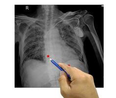 Chest x-ray film of a patient with permanent pacemaker implant in chest body photo