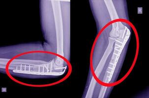 Elbow An olecranon fracture my be held together with plate and screws. photo