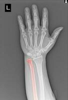 x-ray hands and wrist on white background Medical image concept. photo