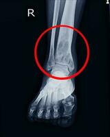 X-ray Rt.Ankle finding intramedullary osterolytic lesion of right distal tibia photo