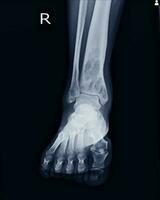 radiografía rt.tobillo hallazgo intramedular osteolítico lesión de Derecha distal tibia foto