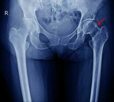 radiografía ambos cadera foto