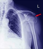 x-ray Fracture neck humerus.medical concept. photo