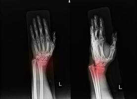 X-ray Left wrist joint Fracture with displacement distal end left radius. photo