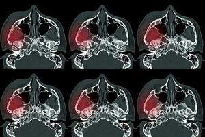 calculado tomografía de orbita desplazado fractura a lateral y medio pared de Derecha orbita. foto