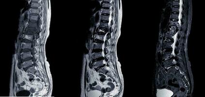 MRI OF THE LUMBOSACRAL SPINE. photo