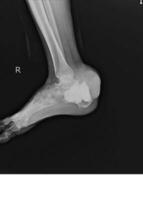Lateral Right foot X-ray showing destruction of the posteroinferior aspect of the calcaneus. photo