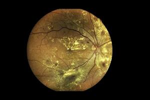 View inside human eye disorders showing retina, optic nerve and macula Severe age-related macular degeneration photo