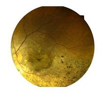 View inside human eye disorders showing retina, optic nerve and macula Severe age-related macular degeneration photo