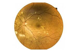 Fundus photography Madical Retina Abnormal isolated on white background. photo