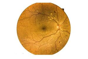 fondo de ojo fotografía loco retina anormal aislado en blanco antecedentes. foto