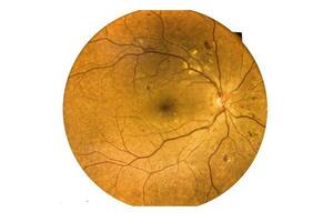 Fundus photography Madical Retina Abnormal isolated on white background. photo