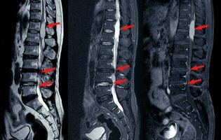 MRI scan of lumbar spines of a patient finding Spinal mass at Lt.side T12-L1 level Severe bulging disc L3-4 causing bilateral L4 nerve root compression  and spinal stenosis on arrow point. photo