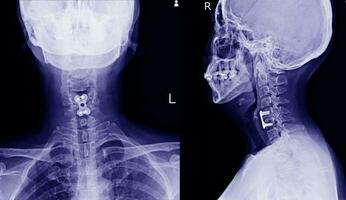 C-Spine x-ray spinal fication of C5-6 bodies  No spinal dislocation photo