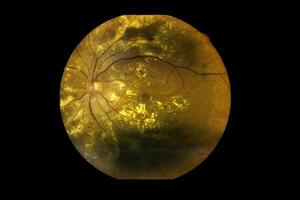 View inside human eye disorders showing retina, optic nerve and macula Severe age-related macular degeneration photo