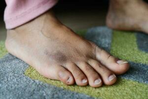 close up of women feet with swelling photo