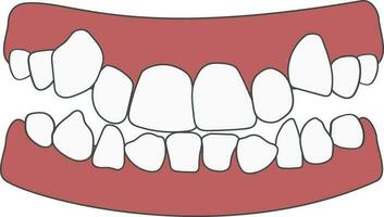 Orthodontic problem teeth crowding. Abnormal eruption. Opposite occlusion, open bite, crowded teeth, cavities, dentition. Vector illustration isolated