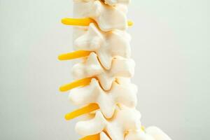 Lumbar spine displaced herniated disc fragment, spinal nerve and bone. Model for treatment medical in the orthopedic department. photo