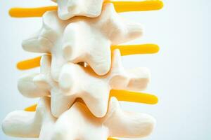 Lumbar spine displaced herniated disc fragment, spinal nerve and bone. Model for treatment medical in the orthopedic department. photo