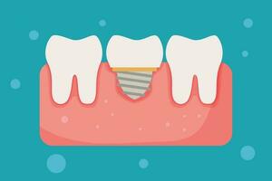 dental implante y sano diente, humano dientes, vector ilustración.