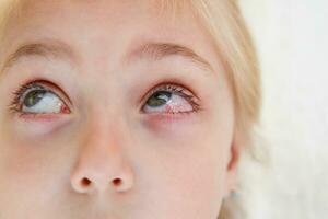 Close-up of a girl with conjunctivitis . photo