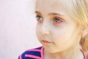 Close-up of a girl with conjunctivitis . photo