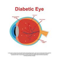 Diabetic Retinopathy vector illustration diagram, anatomical scheme.