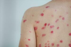 Treatment of ulcers from chickenpox, chickenpox with a healing cream on the skin of a child. Close-up of a child's back treated with red medicine. photo