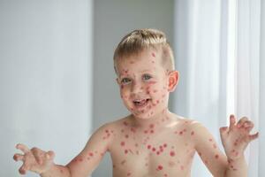 Portrait of a grimacing boy with a rash on his face from chicken pox. Chickenpox in a child is treated with a red healing cream on the child's skin. photo