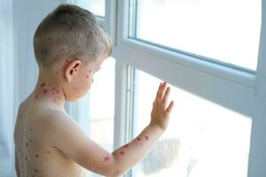 A sad boy with ulcers from chickenpox looks sadly out the window. A child treated with red medicine. Quarantine photo