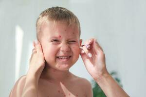 tratamiento de úlceras desde varicela, varicela con un curación crema en el piel de un niño. mamá trata el niño cara con rojo medicamento. foto