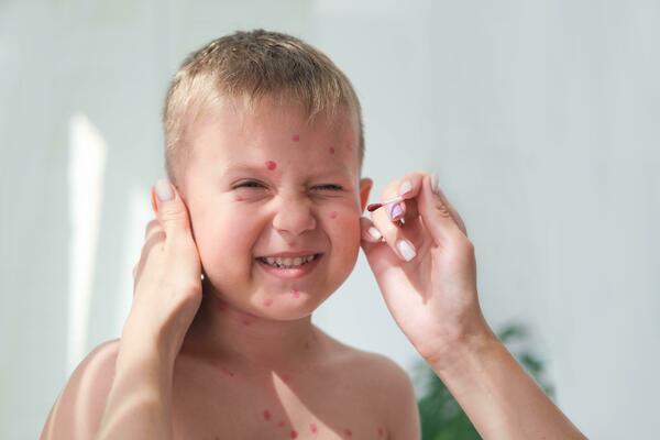 Chicken Pox Stock Photos, Images and Backgrounds for Free Download