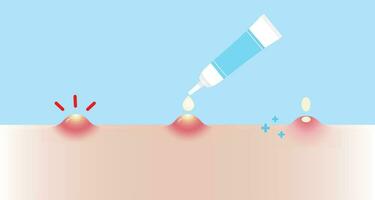 Direction for use acne pimple treatment for pustule vector illustration on sky blue background. How to use, step for use acne cream, gel and lotion absorbing inflammatory acne on skin face.