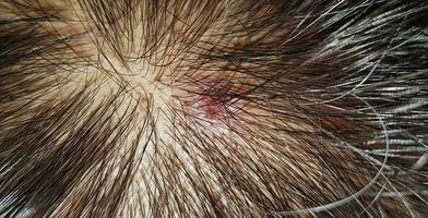 Scabs On The Scalp, wound on the scalps or Lichen planus follicularis capillitii, itch on the scalps photo