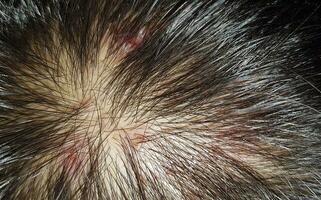 Scabs On The Scalp, wound on the scalps or Lichen planus follicularis capillitii, itch on the scalps photo