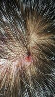 Scabs On The Scalp, wound on the scalps or Lichen planus follicularis capillitii, itch on the scalps photo