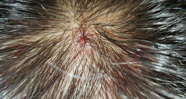 Scabs On The Scalp, wound on the scalps or Lichen planus follicularis capillitii, itch on the scalps photo