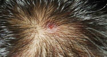 Scabs On The Scalp, wound on the scalps or Lichen planus follicularis capillitii, itch on the scalps photo