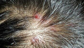 Scabs On The Scalp, wound on the scalps or Lichen planus follicularis capillitii, itch on the scalps photo