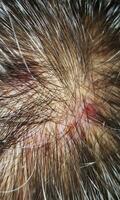 Scabs On The Scalp, wound on the scalps or Lichen planus follicularis capillitii, itch on the scalps photo